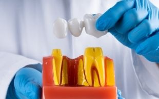 tooth bridges