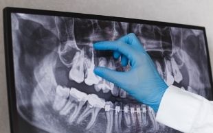 root canal hamilton